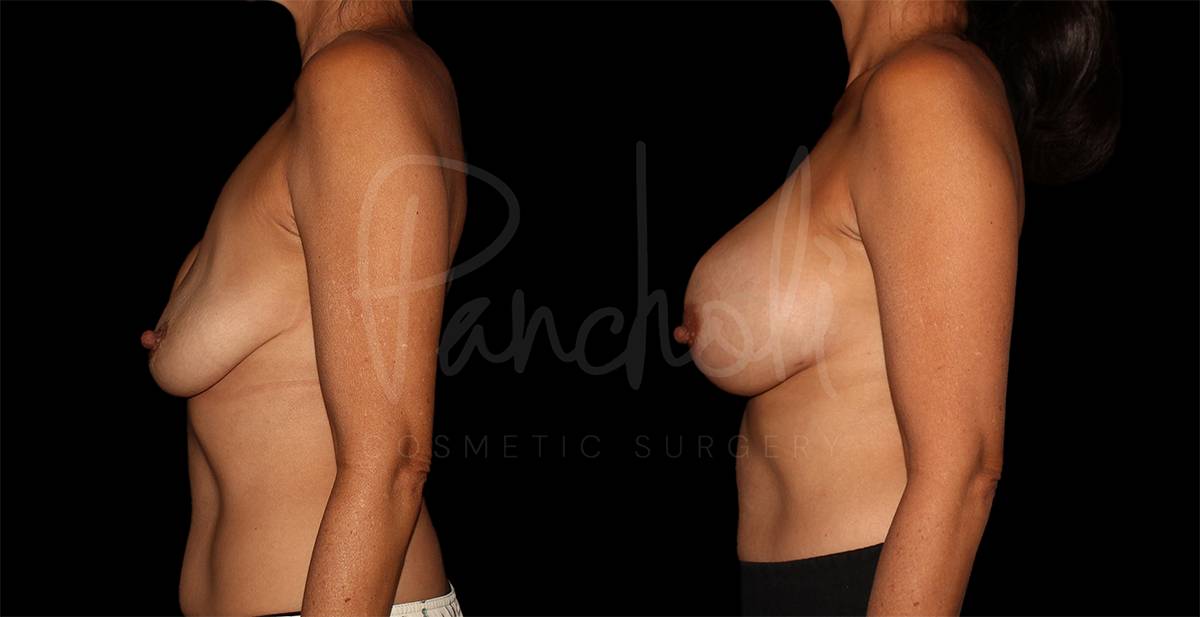 before and after breast implant replacement side view case 3023
