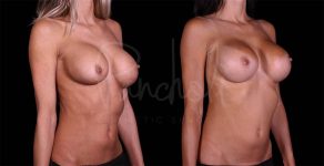 before and after breast augmentation right angle view case 3030