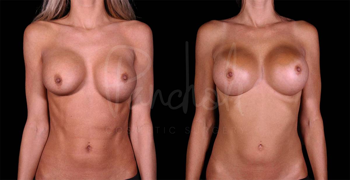 before and after breast augmentation front view case 3030