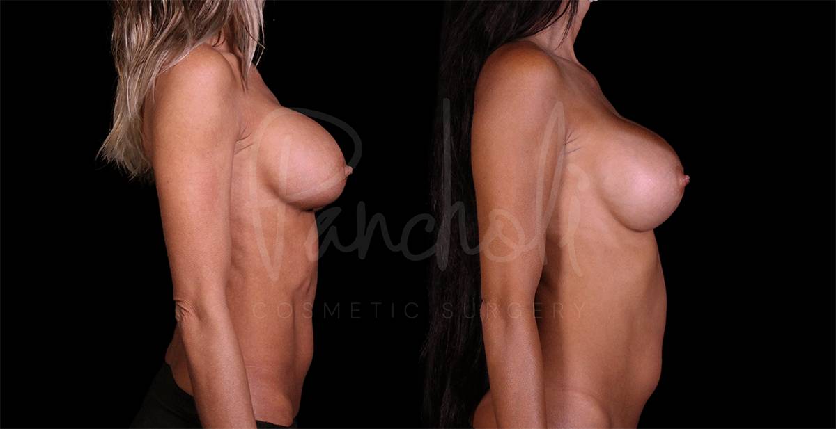 before and after breast augmentation right side view case 3030