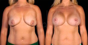 before and after breast lift with implants front view female patient case 1872
