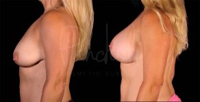 before and after breast lift with implants side view female patient case 1872