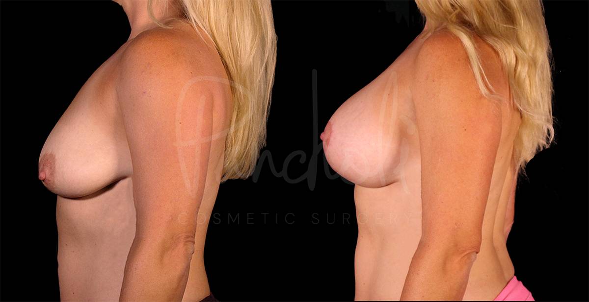 before and after breast lift with implants side view female patient case 1872