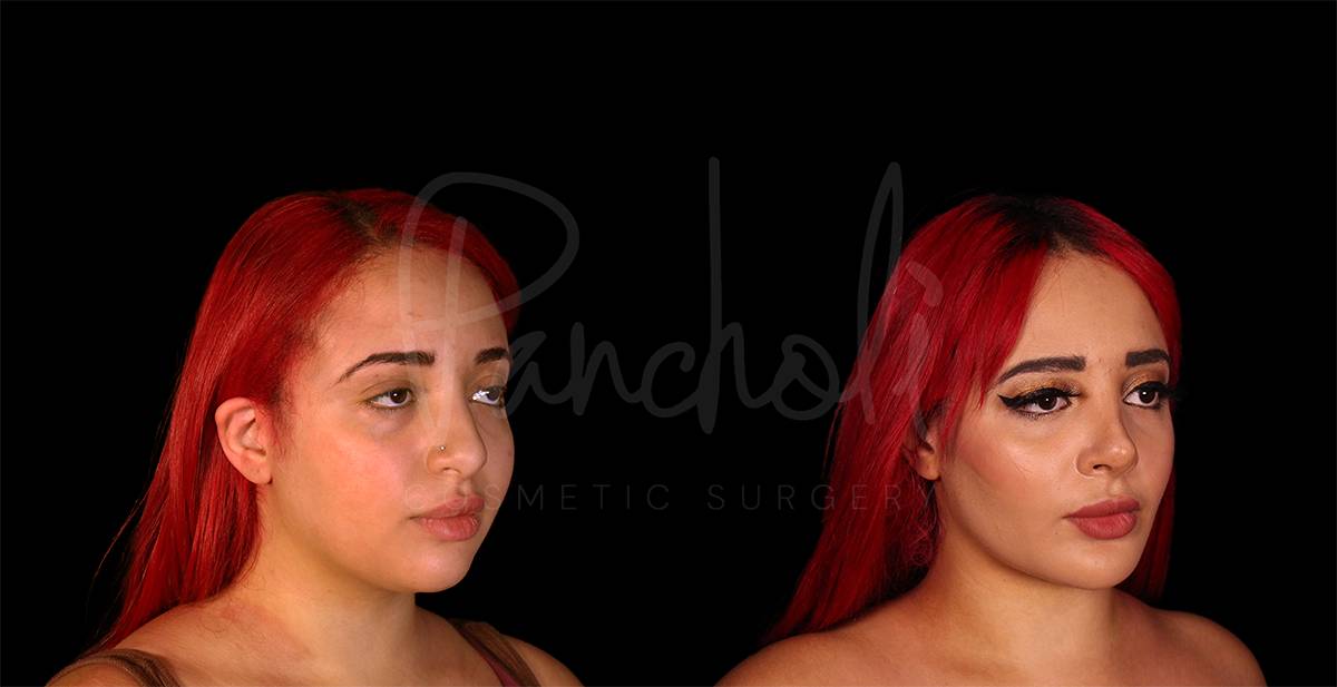 before and after buccal fat removal angle view female patient case 1876