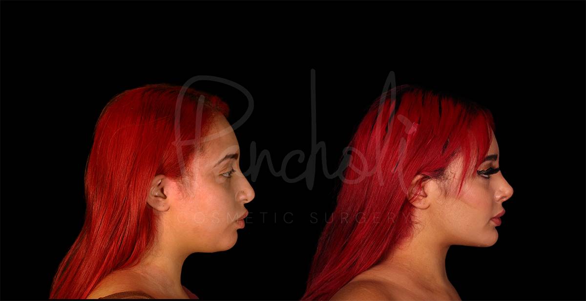 before and after buccal fat removal side view female patient case 1876