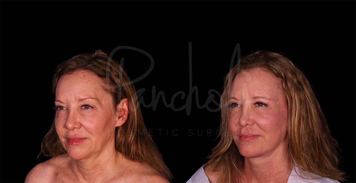 before and after facelift angle view female patient case 1880