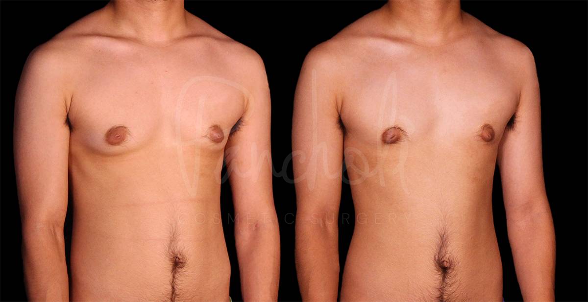 before and after FTM Chest Masculization right angle view case 1889