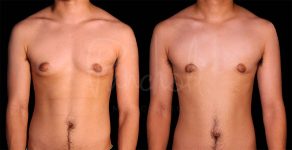 before and after FTM Chest Masculization front view case 1889