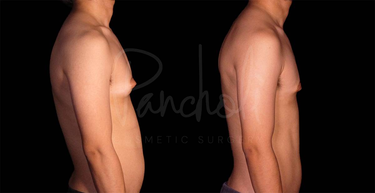 before and after FTM Chest Masculization right side view case 1889