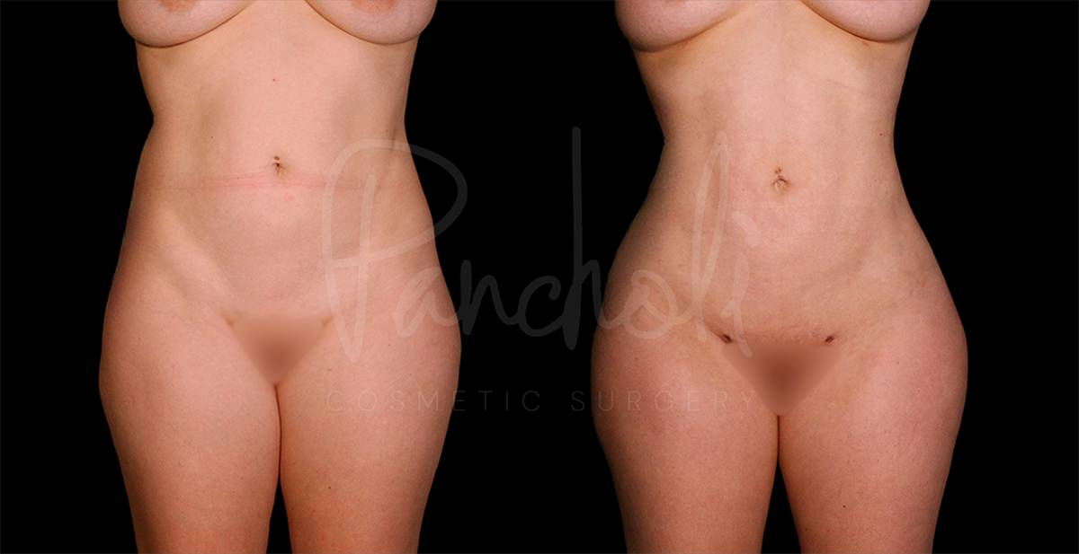 before and after Lipo with fat transfer to buttocks front view female case 1893