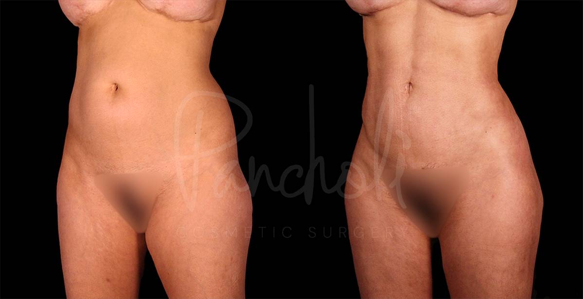 before and after liposuction left angle view female patient case 3086