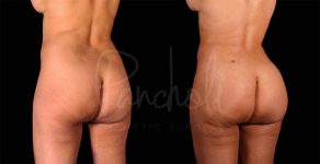 before and after liposuction back angle view female patient case 3086