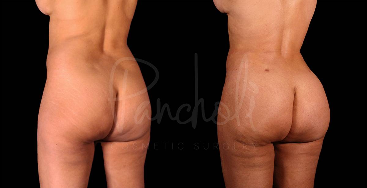 before and after liposuction back angle view female patient case 3086
