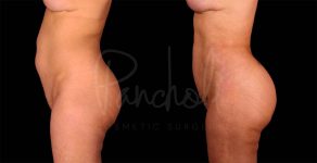 before and after liposuction left side view female patient case 3086