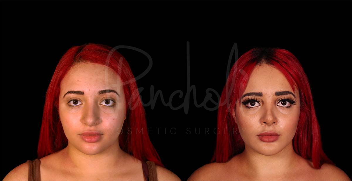 before and after submentoplasty front view case 1899