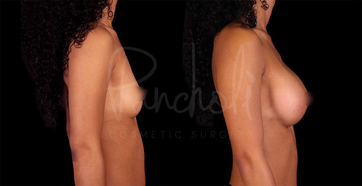 breast-augmentation--1162-1