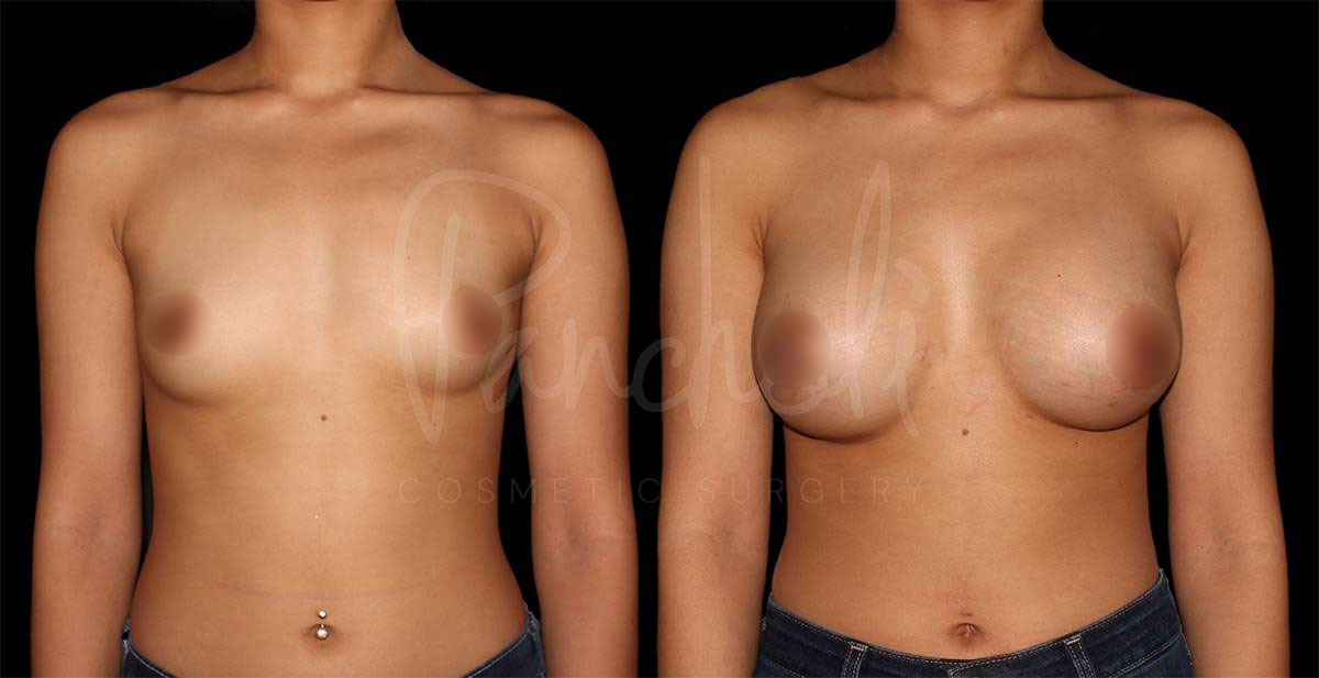 breast-augmentation--1864-1