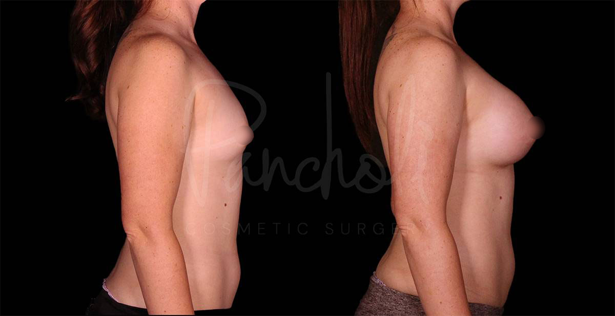 breast-augmentation--8142-1