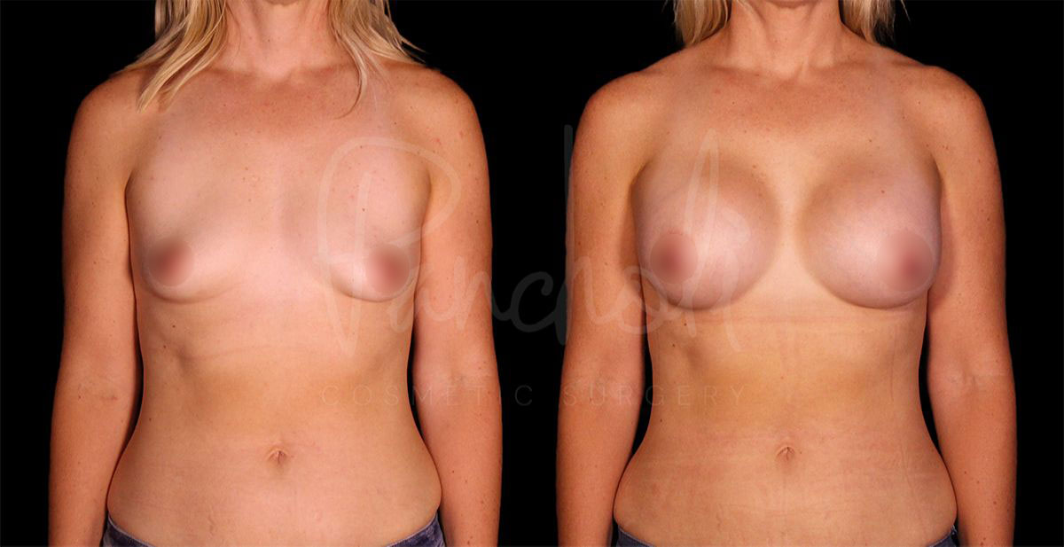 breast-augmentation--8275-1