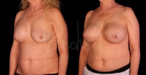 before and after breast implant replacement angle view female patient case 8334