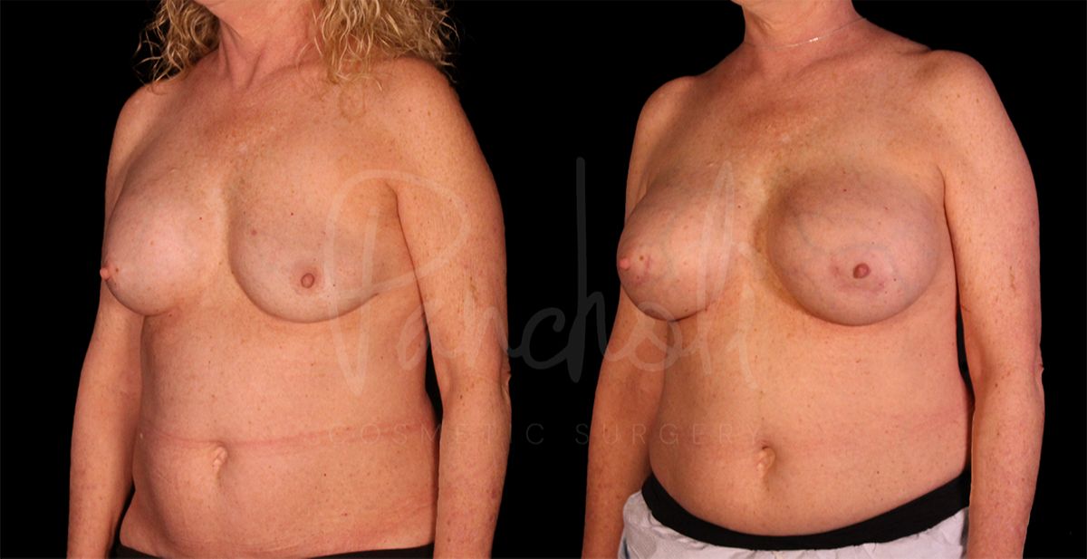 before and after breast implant replacement angle view female patient case 8334