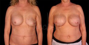 before and after breast implant replacement front view female patient case 8334