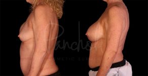 before and after breast implant replacement side view female patient case 8334