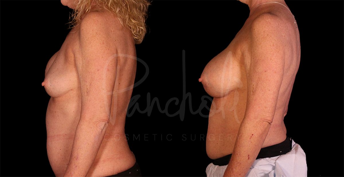 before and after breast implant replacement side view female patient case 8334