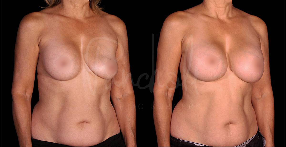 breast-implant-replacement--8109-1