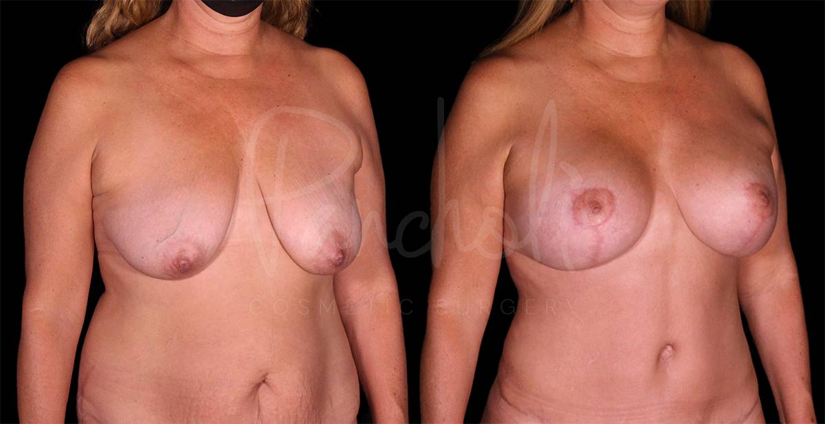 before and after breast lift with implants angle view