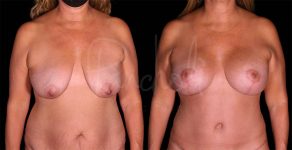 before and after breast lift with implants front view