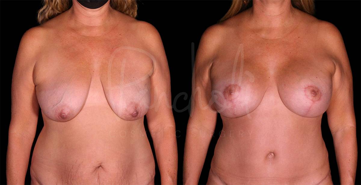 before and after breast lift with implants front view