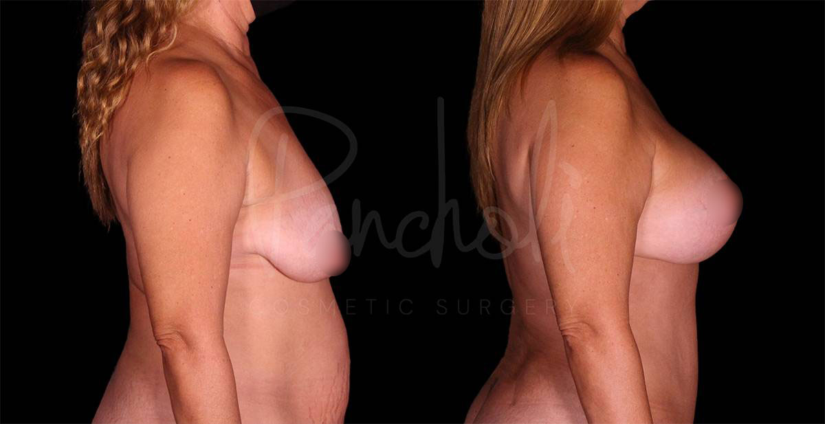 breast-lift--8134-1