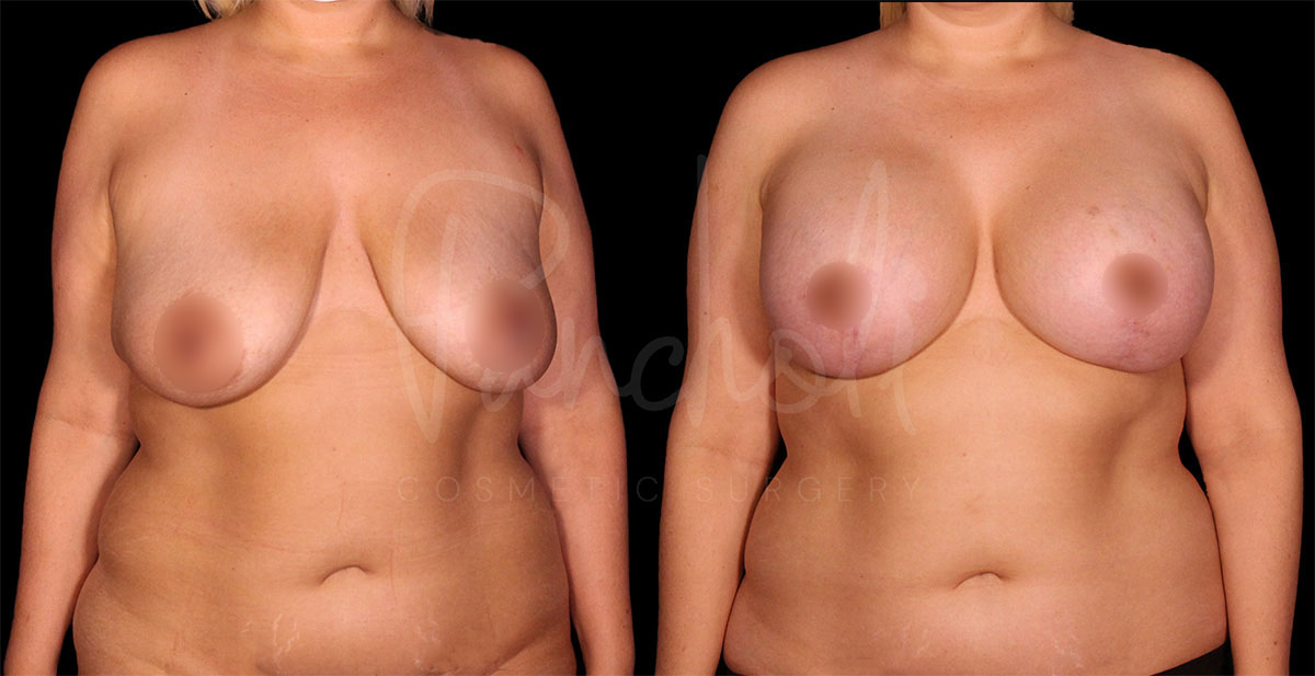 breast-lift-with-implants--1170-1
