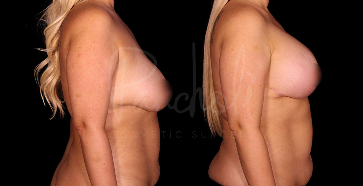 breast-lift-with-implants--1171-1
