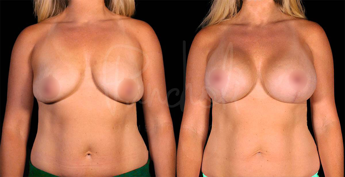 breast-lift-with-implants--1874-1