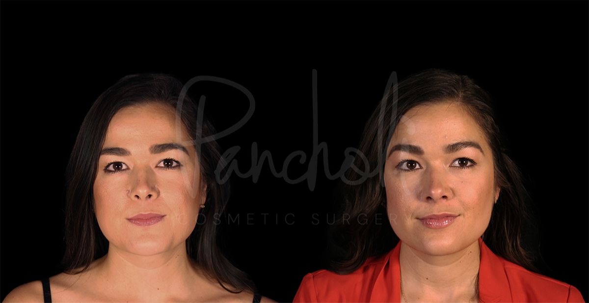 before and after buccal fat removal front view female patient case 8326