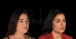 before and after buccal fat removal angle view female patient case 8326