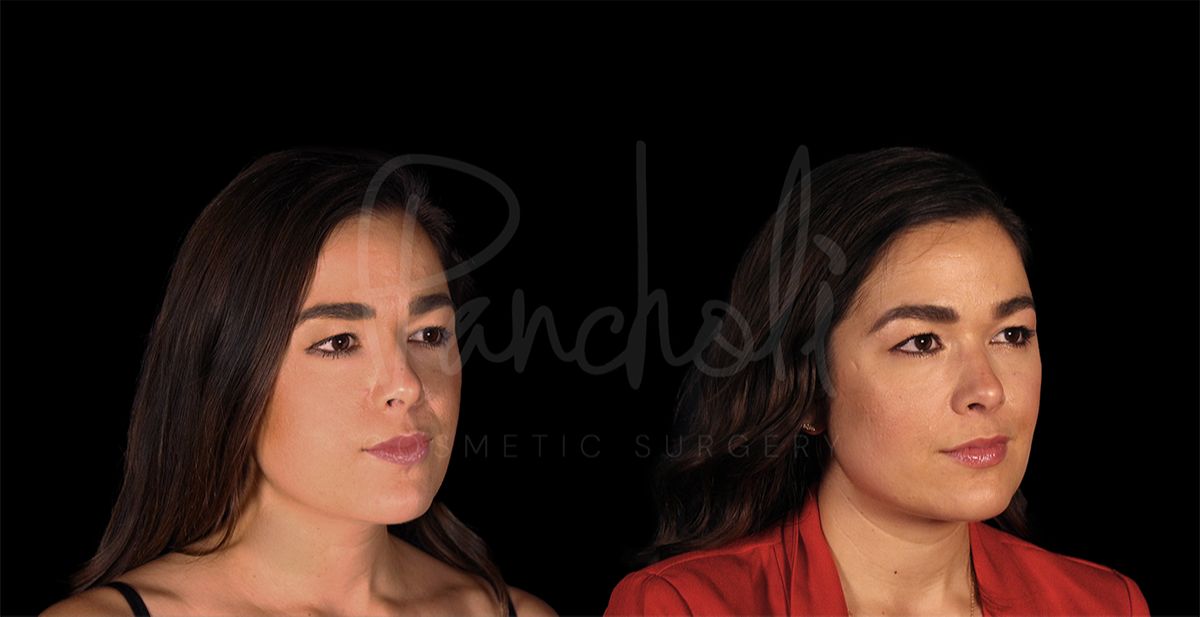 before and after buccal fat removal angle view female patient case 8326