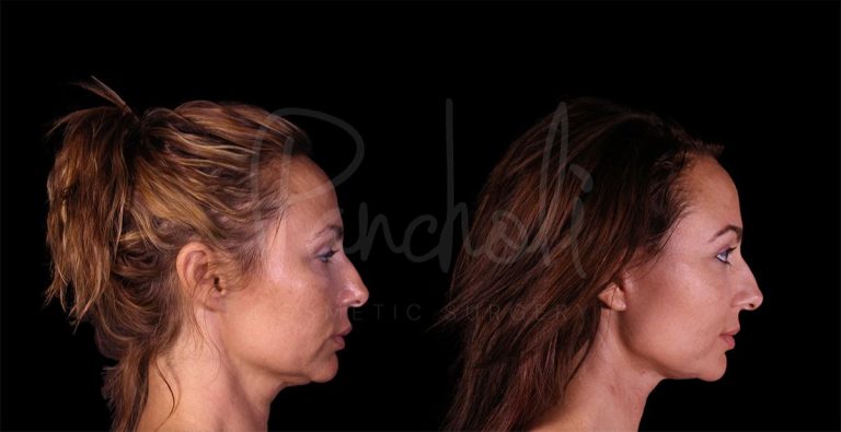 before and after lower Face and Neck Lift side view female patient case 8330