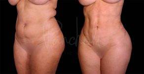 before and after liposuction in the stomach female patient angle view case 8030