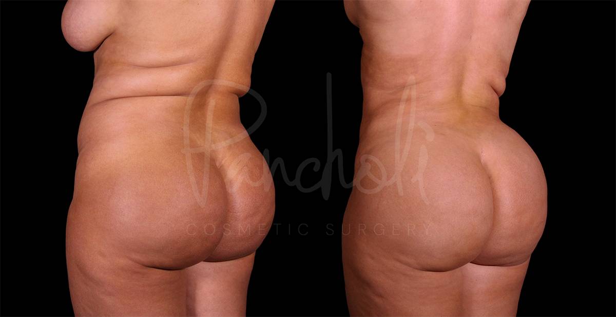 before and after liposuction in the stomach female patient side angle view case 8030