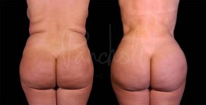 before and after liposuction in the stomach female patient back view case 8030