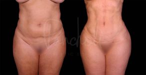 before and after liposuction in the stomach female patient front view case 8030