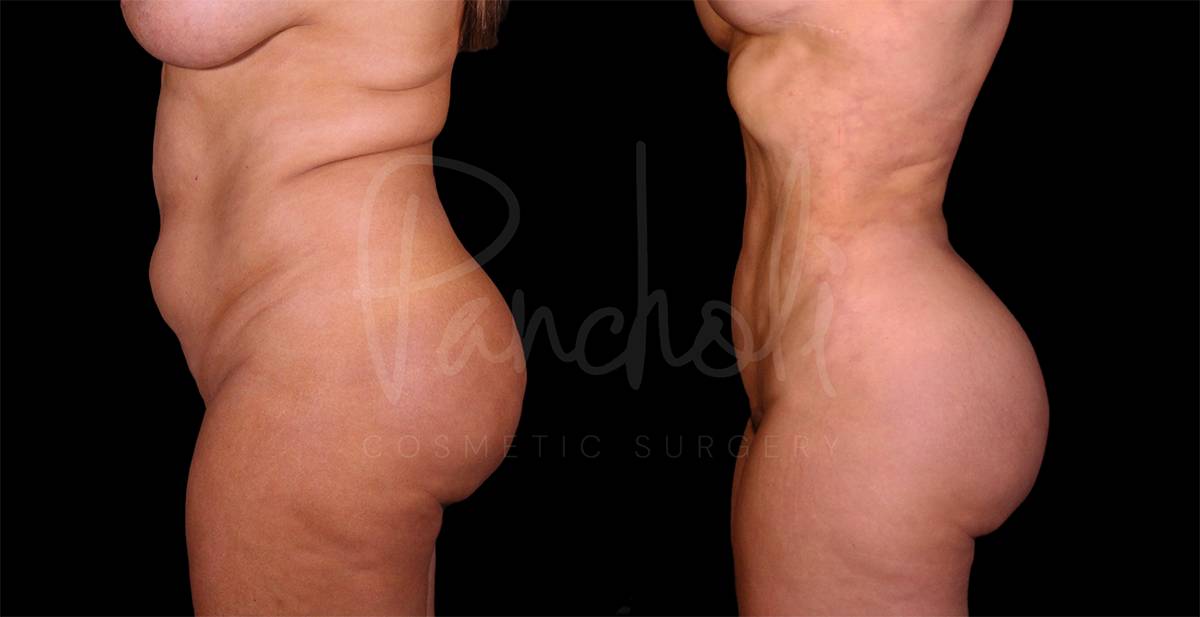before and after liposuction in the stomach female patient side view case 8030