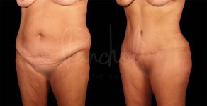 before and after of Tummy Tuck, Liposuction, and BBL female patient angle view case 8060