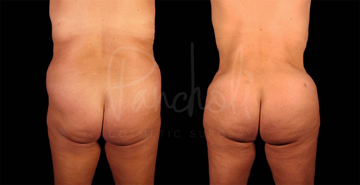 before and after of Tummy Tuck, Liposuction, and BBL female patient back view case 8054