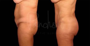 before and after of Tummy Tuck, Liposuction, and BBL female patient front view case 8060