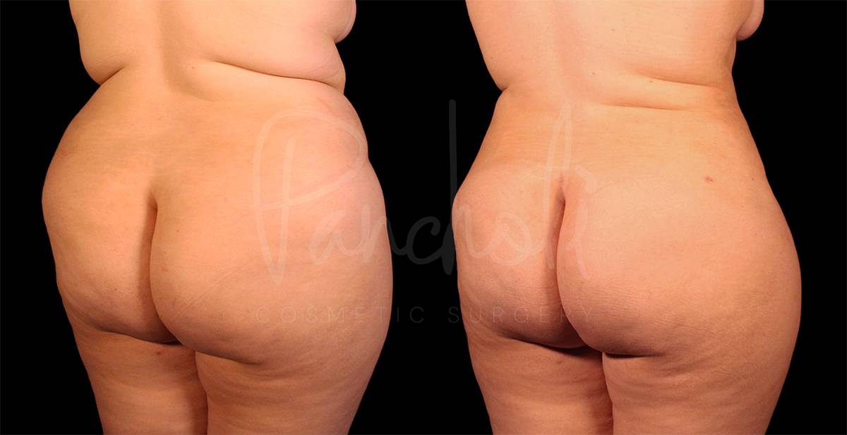 before and after liposuction of the stomach female patient back angle view case 8060