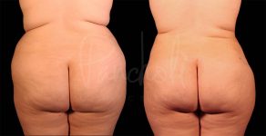 before and after liposuction of the stomach female patient back view case 8060